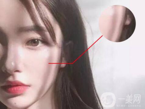 磨顴骨*果怎么樣 有什么風(fēng)險嗎？