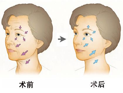 *去皺多少錢 除皺的方法有哪些