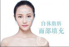 面部自體脂肪填充貴嗎？一般多少錢？