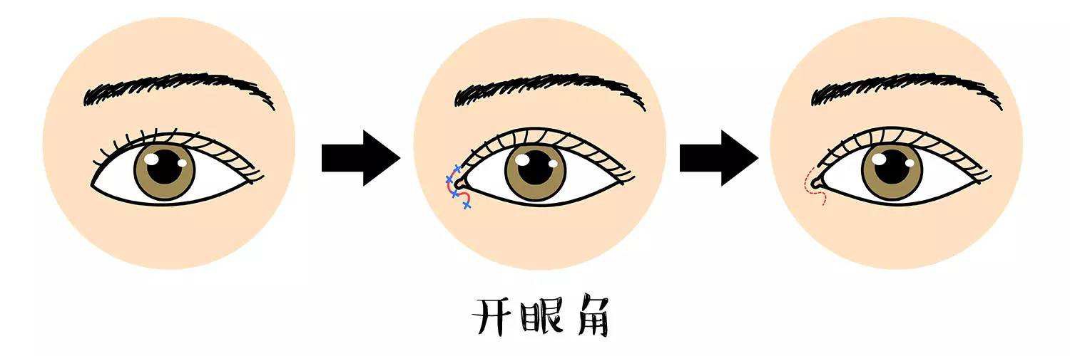 開眼角手術(shù)前后圖 開眼角注意事項