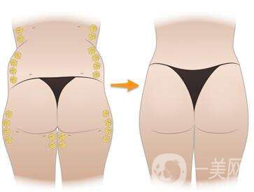 臀部強(qiáng)化手術(shù)多久恢復(fù) 臀部強(qiáng)化注意事項