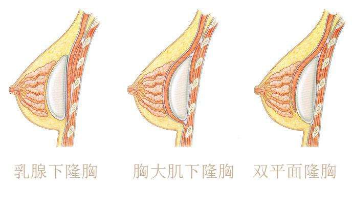 雙平面隆胸的缺點(diǎn)是什么 *果自然嗎