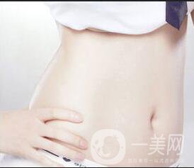腹壁成形術風險,腹壁成形術注意事項