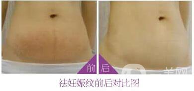 腹壁成形術風險,腹壁成形術注意事項