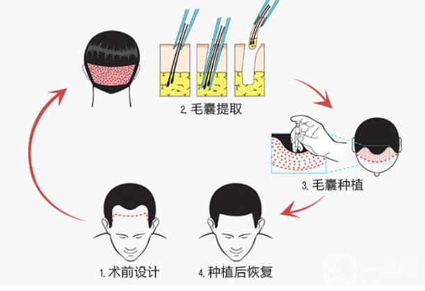 植發(fā)的*果是*性的嗎 它的原理是什么？