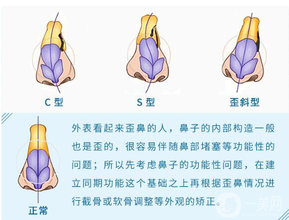 歪鼻矯正手術(shù)是怎樣的 手術(shù)方法有哪些？