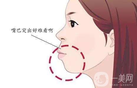 雙頜前突是什么 凸嘴不好看該怎么辦？