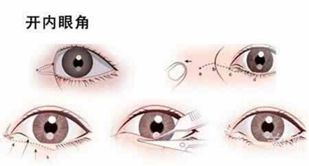 開眼角的風(fēng)險(xiǎn)大嗎 開眼角*果好不好
