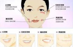 酒窩整形價(jià)格多少錢？多久恢復(fù)？