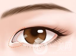 開(kāi)眼角的*果怎么樣 好不好？