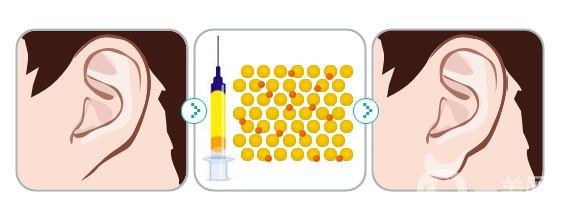注射玻尿酸豐耳垂前后 豐耳垂*果好不好？