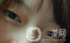 上海九院張波醫(yī)生好不好？醫(yī)生雙眼皮案例附照片