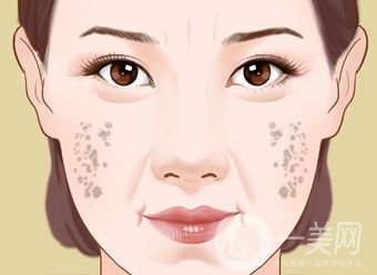 怎樣治老年斑 調節(jié)方法有哪些？