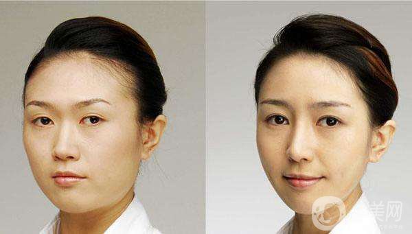 開眼角*果*嗎？開眼角前后照片