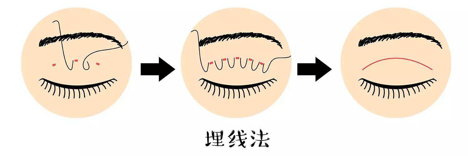 不開刀的雙眼皮手術有哪些？