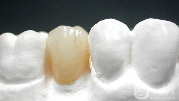 烤瓷牙一般要多少錢 貴不貴？