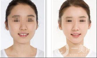 激光溶脂瘦臉會反彈嗎,激光溶脂瘦臉多少錢