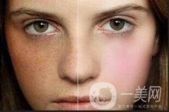 皮膚斑點：老年斑、鼴鼠、黃褐斑和雀斑的區(qū)別