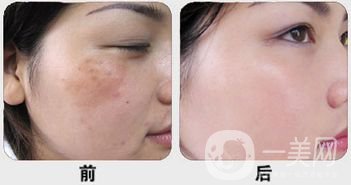 白瓷娃娃做完多久*果？幾次*果？
