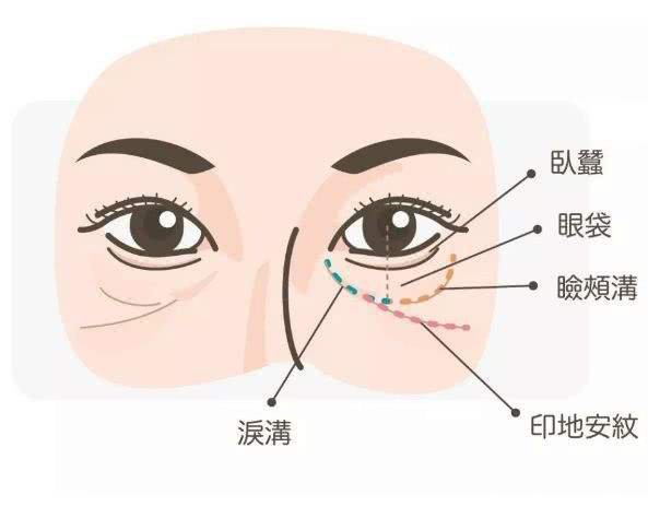 淚勾填充多少錢呢 哪些因素影響淚溝價格