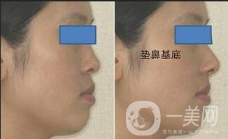 墊鼻基底材料,墊鼻基底術后護理