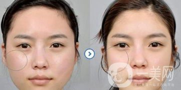 改變臉型手術(shù)要多少錢呢？