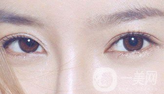 怎么開(kāi)眼角 開(kāi)眼角有什么危害嗎？