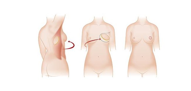 北京乳房再造術(shù)多少錢?*果維持多久？