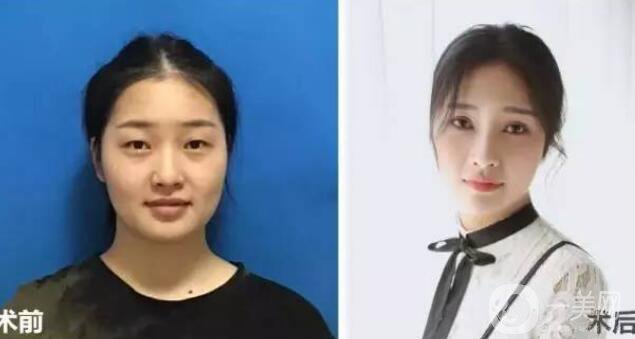 開眼角疼嗎？這幾種情況開眼角*果堪比換頭！