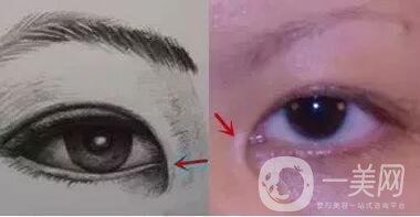 開眼角疼嗎？這幾種情況開眼角*果堪比換頭！