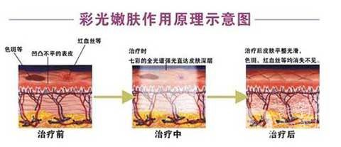 彩光嫩膚好嗎？*果如何？
