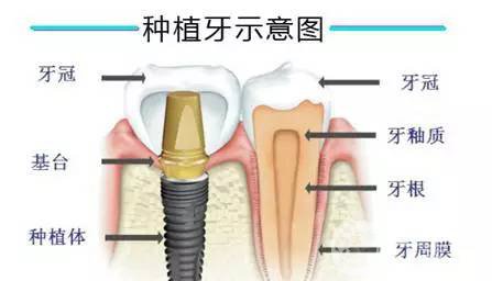 人工種植牙齒價(jià)格 手術(shù)費(fèi)用多少錢？