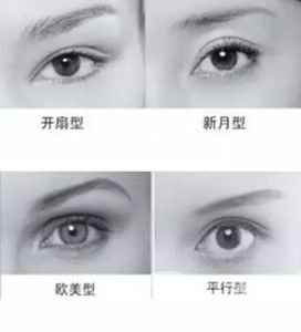 全切雙眼皮多久自然 手術(shù)有年齡限制嗎？
