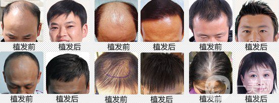 植發(fā)費用多少錢 價格高不高？