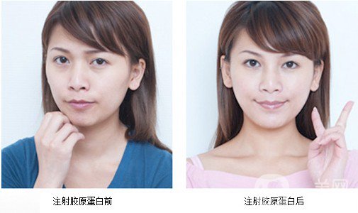 膠原蛋白針的副作用 危害有哪些？