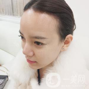 植發(fā)半年后案例 植發(fā)怎么樣？