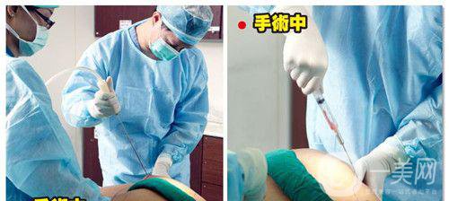 什么是抽脂手術(shù)？*果好嗎？