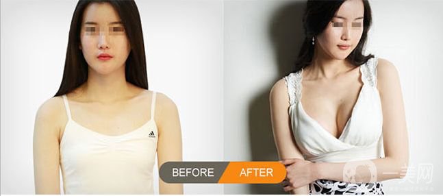 什么是隆胸手術(shù) 乳房植入物類(lèi)型