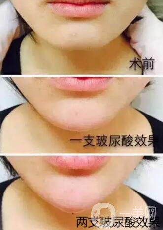 玻尿酸豐下巴需要幾針？?jī)舍槻Ｄ蛩嵯掳?果圖