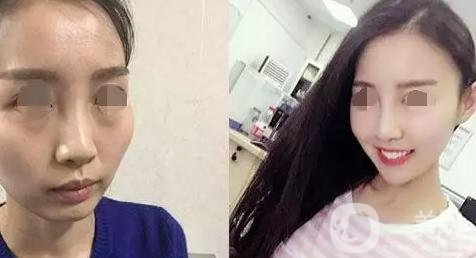 磨顴骨照片 磨顴骨*果怎么樣？
