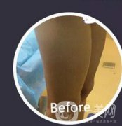 腿部環(huán)形抽脂果如何？小粗腿到筷子腿就這么簡(jiǎn)單
