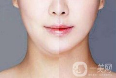 下巴抽脂有什么風(fēng)險(xiǎn)？醫(yī)生說(shuō)副作用有這些