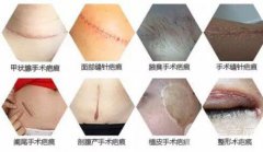 怎樣修復(fù)手術(shù)疤痕？祛疤方法有哪些？