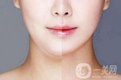 雙下巴抽脂多久恢復(fù)？雙下巴抽脂七天后能相親嗎