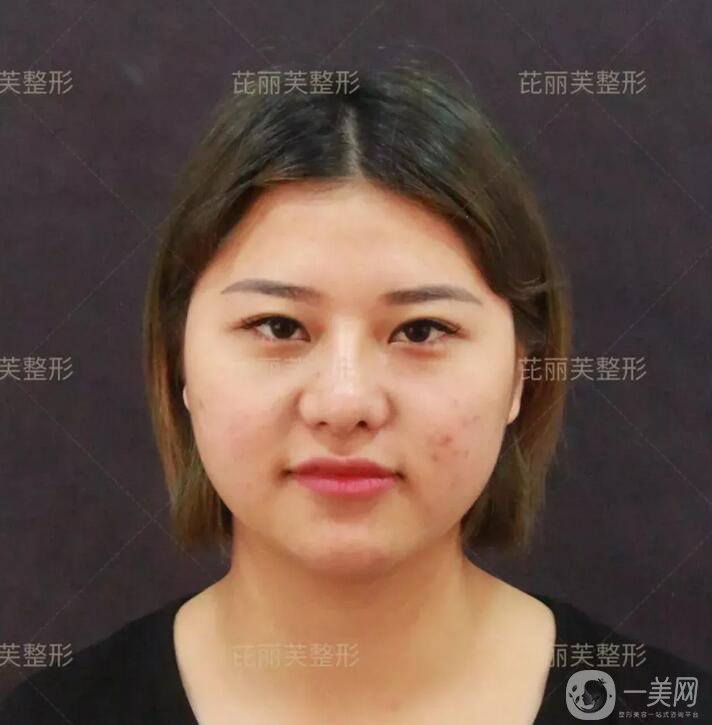 面部光纖溶脂