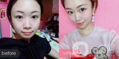 隆下巴手術(shù)前后果圖 隆下巴的風(fēng)險(xiǎn)和恢復(fù)