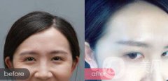 *對魚尾紋的作用：注射部位和副作用