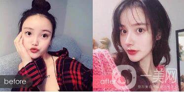 朝天鼻整形多少錢(qián)?*丑的幾種鼻子圖片