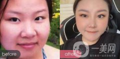 蒜頭鼻整形圖片 蒜頭鼻整形多少錢？