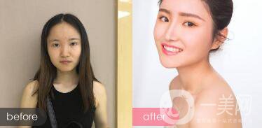 蒜頭鼻整形圖片 蒜頭鼻整形多少錢？